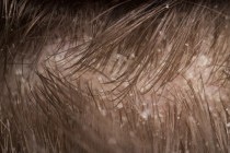 كيف تتعامل مع قشر الشعر كيف تتعامل مع قشر الشعر